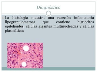 Diagnóstico
La histología muestra una reacción inflamatoria
lipogranulomatosa que contiene histiocitos
epitelioides, células gigantes multinucleadas y células
plasmáticas
 