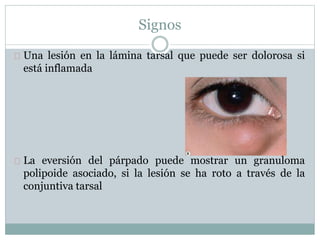 Signos
Una lesión en la lámina tarsal que puede ser dolorosa si
está inflamada
La eversión del párpado puede mostrar un granuloma
polipoide asociado, si la lesión se ha roto a través de la
conjuntiva tarsal
 