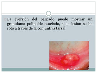 La eversión del párpado puede mostrar un
granuloma polipoide asociado, si la lesión se ha
roto a través de la conjuntiva tarsal
 