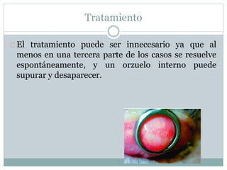 Tratamiento
El tratamiento puede ser innecesario ya que al
menos en una tercera parte de los casos se resuelve
espontáneamente, y un orzuelo interno puede
supurar y desaparecer.
 