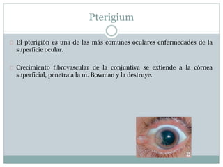 El pterigión es una de las más comunes oculares enfermedades de la
superficie ocular.
Crecimiento fibrovascular de la conjuntiva se extiende a la córnea
superficial, penetra a la m. Bowman y la destruye.
Pterigium
 
