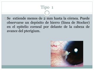 Tipo 1
Se extiende menos de 2 mm hasta la córnea. Puede
observarse un depósito de hierro (línea de Stocker)
en el epitelio corneal por delante de la cabeza de
avance del pterigium.
 