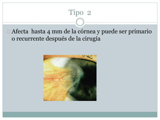 Tipo 2
Afecta hasta 4 mm de la córnea y puede ser primario
o recurrente después de la cirugía
 