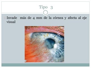 Tipo 3
Invade más de 4 mm de la córnea y afecta al eje
visual
 