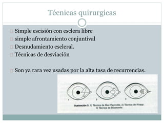 Técnicas quirurgicas
Simple escisión con esclera libre
simple afrontamiento conjuntival
Desnudamiento escleral.
Técnicas de desviación
Son ya rara vez usadas por la alta tasa de recurrencias.
 