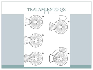 TRATAMIENTO QX
 