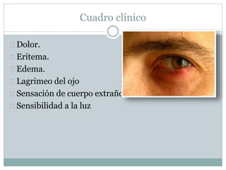 Dolor.
Eritema.
Edema.
Lagrimeo del ojo
Sensación de cuerpo extraño
Sensibilidad a la luz
Cuadro clínico
 