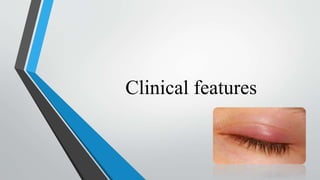 Clinical features
 