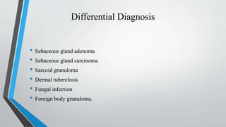 Differential Diagnosis
• Sebaceous gland adenoma
• Sebaceous gland carcinoma
• Sarcoid granuloma
• Dermal tuberclosis
• Fungal infection
• Foreign body granuloma.
 