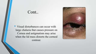 Cont..
• Visual disturbances can occur with
large chalazia that causes pressure on
Cornea and astigmatism may arise
when the lid mass distorts the corneal
contour.
 