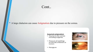 Cont..
• A large chalazion can cause Astigmatism due to pressure on the cornea.
 