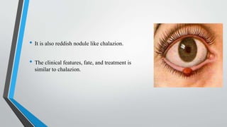 • It is also reddish nodule like chalazion.
• The clinical features, fate, and treatment is
similar to chalazion.
 