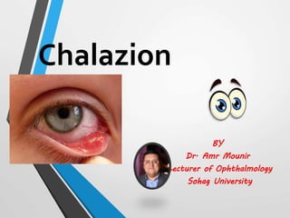 Chalazion
BY
Dr. Amr Mounir
Lecturer of Ophthalmology
Sohag University
 
