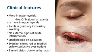 Clinical features
• More in upper eyelids
> No. Of Meibomian glands
are more in upper eyelids
• Painless gradually increasing
swelling
• No external signs of acute
inflammation
• Small nodule on palpation
• Eversion shows red or reddish
yellow conjuctiva over nodule
• Blurred vision due to astigmatism
 