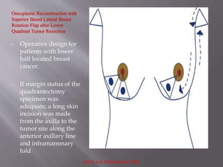 Oncoplastic Reconstruction with
Superior Based Lateral Breast
Rotation Flap after Lower
Quadrant Tumor Resection
• Operative design for
patients with lower
half located breast
cancer.
• If margin status of the
quadrantectomy
specimen was
adequate, a long skin
incision was made
from the axilla to the
tumor site along the
anterior axillary line
and inframammary
fold
Kim J. et al. J Breast Cancer. 2012
 