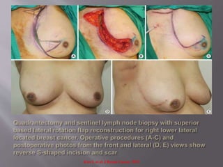 Kim J. et al. J Breast Cancer. 2012
 