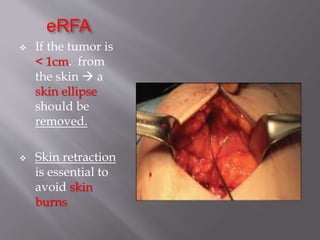 eRFA
 If the tumor is
< 1cm. from
the skin  a
skin ellipse
should be
removed.
 Skin retraction
is essential to
avoid skin
burns
 