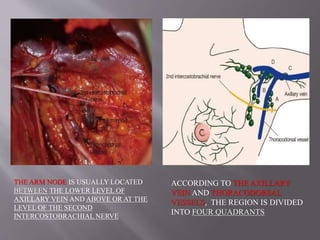 THE ARM NODE IS USUALLY LOCATED
BETWEEN THE LOWER LEVEL OF
AXILLARY VEIN AND ABOVE OR AT THE
LEVEL OF THE SECOND
INTERCOSTOBRACHIAL NERVE
ACCORDING TO THE AXILLARY
VEIN AND THORACODORSAL
VESSELS, THE REGION IS DIVIDED
INTO FOUR QUADRANTS
 