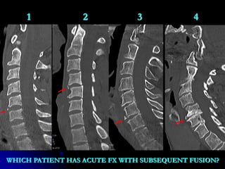 1 2 3 4
WHICH PATIENT HAS ACUTE FX WITH SUBSEQUENT FUSION?
 