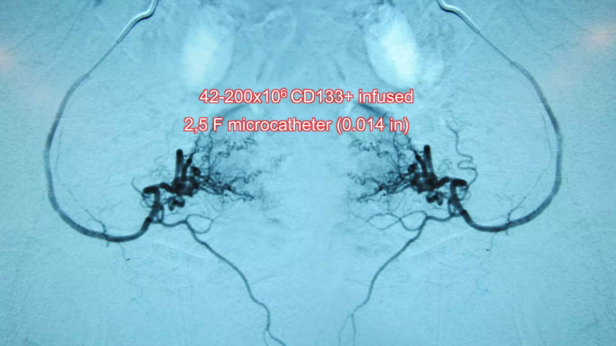 42-200x106 CD133+ infused
2,5 F microcatheter (0.014 in)