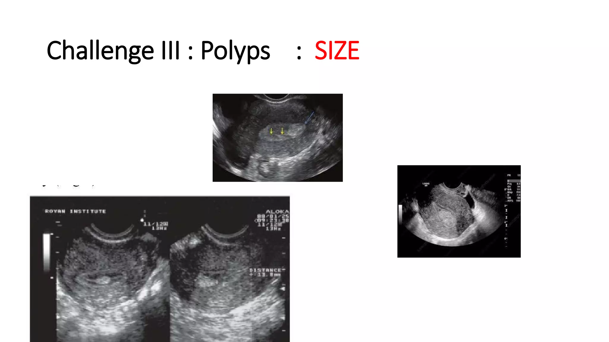 Challenge III : Polyps : SIZE