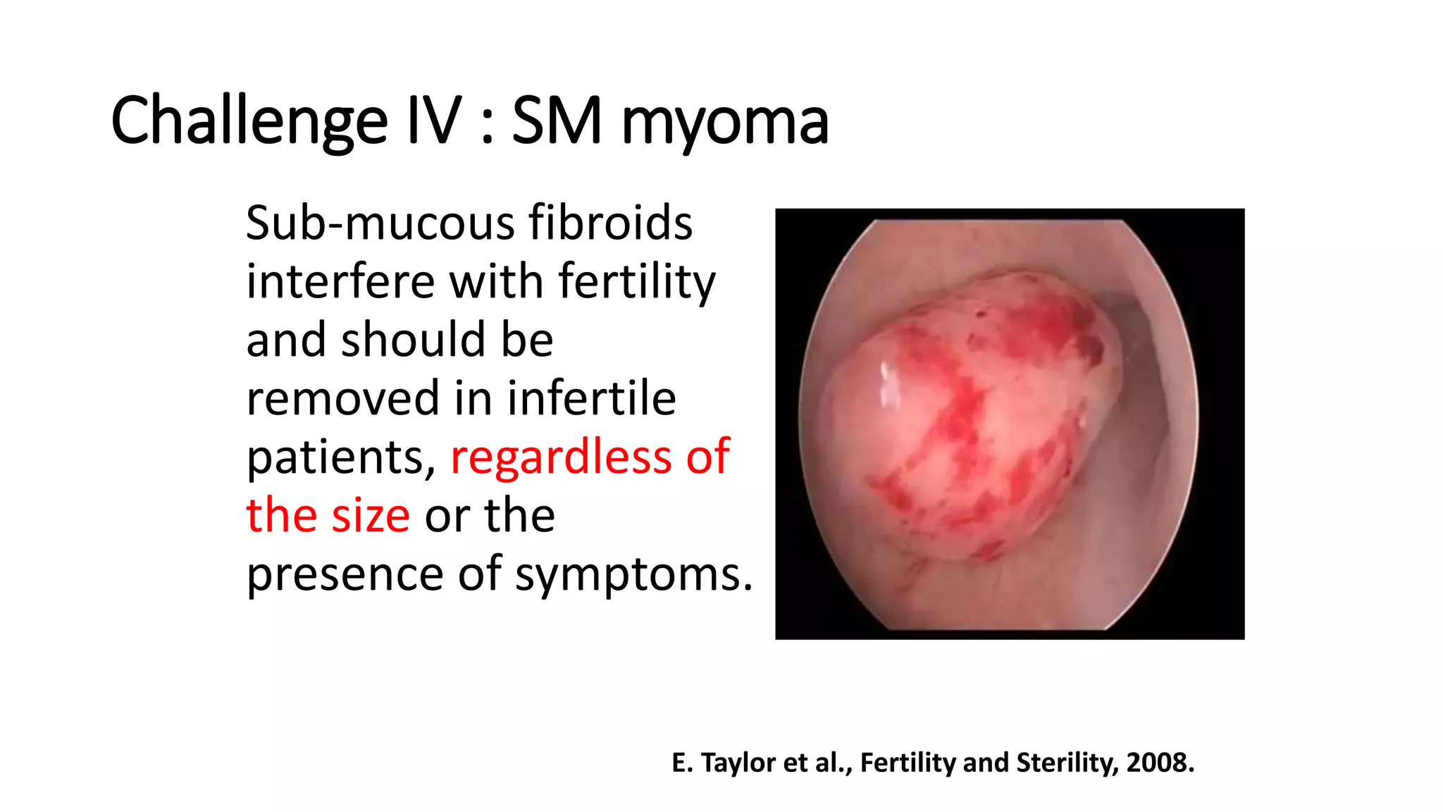 Challenge IV : SM myoma
Sub-mucous fibroids
interfere with fertility
and should be
removed in infertile
patients, regardless of
the size or the
presence of symptoms.
E. Taylor et al., Fertility and Sterility, 2008.