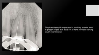 Challenges in working length determination | PPTX