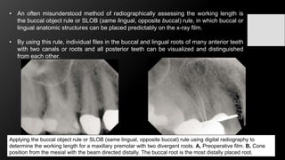 Using Slob Rule Radiograph Challenges in working length determination | PPTX