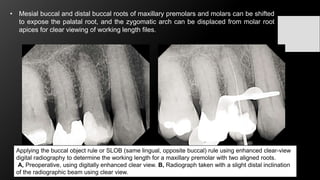Using Slob Rule Radiograph Challenges in working length determination | PPTX