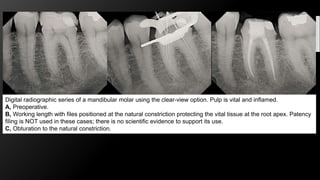 Challenges in working length determination | PPTX