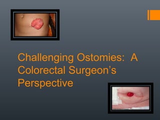 Challenging Ostomies: A
Colorectal Surgeon’s
Perspective
 