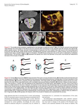 larger diameters than the I-I convention (by 2–4 mm), and switching
to the I-I convention raised a concern that patients at potential risk for
developing life-threatening complications such as aortic dissection
and/or rupture would fall below a threshold for intervention recom-
mendation by current guidelines. Accordingly, the aortic annulus
should be measured using the I-I convention, but we continue to
recommend the L-L convention for measurements of the aortic
root and aorta.
Two-dimensional echocardiographic aortic diameter measure-
ments are preferable to M-mode measurements, because cardiac mo-
tion may result in changes in the position of the M-mode cursor
relative to the maximum diameter of the sinuses of Valsalva. This
Figure 11 The smaller (antero-posterior, sagittal) aortic root diameter is measured using CT (A) or 3D TEE (C, zoomed cross sectional
view) between the inner edges of the left (L) and non-coronary (NC) commissure to the opposite right (R) coronary sinus (A and C,
yellow double arrows). The larger diameter (medial-lateral) is measured from the middle of the right sinus to the most distal point
of the NC sinus (A and C, purple double arrows). Panel B shows zoomed cross-sectional CT views of aortic root at the sinus of
Valsalva level using a double oblique image for orientation. Panel D shows a long-axis view of the aorta in obtained by multiplanar
reconstruction. The red lines in (B) and (D) represent the planes from which the diameter of the aortic root should be measured at
the level of the sinuses of Valsalva.
Figure 12 Correct (A) and incorrect (B, C) measurements of the aortic annulus (double arrows). (A) Centrally positioned diameter and
central closure of leaﬂets. Thin lines correspond to the long axis of the ascending aorta and, orthogonally, to correct orientation of the
annular diameter. (B) Incorrect, eccentric annular measurement. The hinge points are slightly displaced upward and do not corre-
spond to the nadir of the cusp attachments, with incomplete opening and closing of leaﬂets. (C) Incorrect, oblique annular measure-
ment. The annulus is ‘‘virtual’’ and only deﬁned by the hinge-points of the three aortic valve leaﬂets. As such, much of the ring is
without a visible anatomic structure. However, its location on any long-axis two-dimensional view can be approximated since the
plane of the virtual annulus is approximately perpendicular to the long-axis of the aorta. When bisecting the maximum dimension
of the annulus in the sagittal plane, one will image the right coronary cusp anteriorly and the ﬁbrous trigone between the left and
noncoronary cusps posteriorly. Because only one anatomic marker (the RCC hinge-point) is seen, the opposing annulus must be
approximated with a measurement that is perpendicular to the long axis of the aorta. Attempting to measure what you believe to
be 2 hinge-points (B and C) typically will measure within the sinuses of Valsalva and overestimate the annulus.
Journal of the American Society of Echocardiography
Volume 28 Number 1
Lang et al 31
 