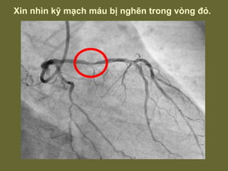 Xin nhìn kỹ mạch máu bị nghẽn trong vòng đỏ. 