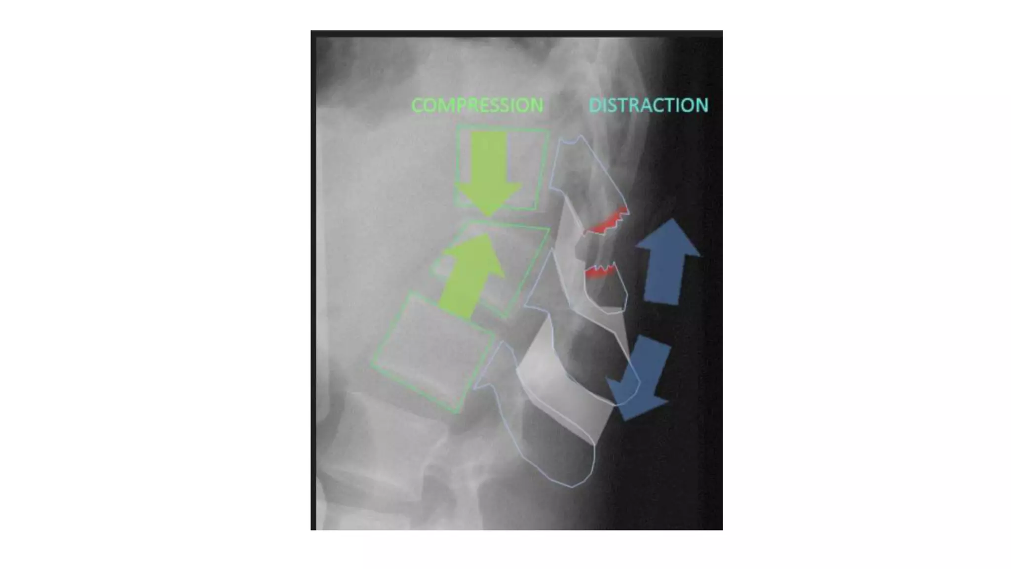 Chance fracture | PPTX