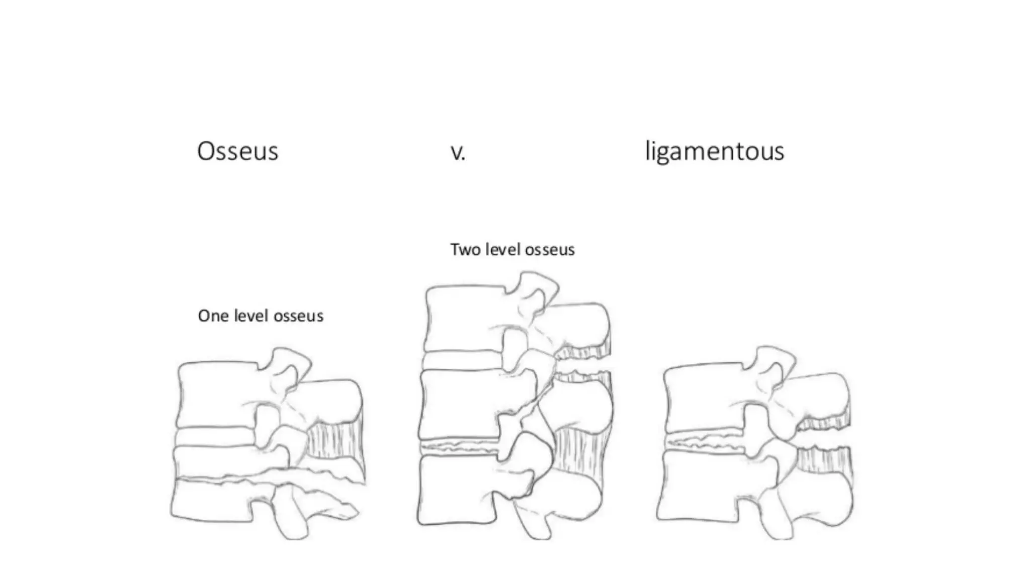 Chance fracture | PPTX