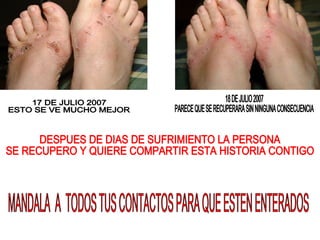 17 DE JULIO 2007 ESTO SE VE MUCHO MEJOR 18 DE JULIO 2007 PARECE QUE SE RECUPERARA SIN NINGUNA CONSECUENCIA DESPUES DE DIAS DE SUFRIMIENTO LA PERSONA  SE RECUPERO Y QUIERE COMPARTIR ESTA HISTORIA CONTIGO MANDALA  A  TODOS TUS CONTACTOS PARA QUE ESTEN ENTERADOS 