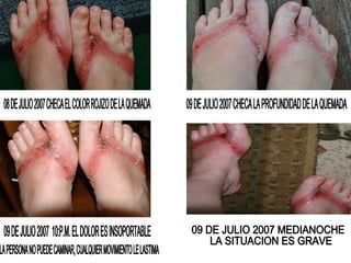 08 DE JULIO 2007 CHECA EL COLOR ROJIZO DE LA QUEMADA 09 DE JULIO 2007 CHECA LA PROFUNDIDAD DE LA QUEMADA 09 DE JULIO 2007  10:P.M. EL DOLOR ES INSOPORTABLE LA PERSONA NO PUEDE CAMINAR, CUALQUIER MOVIMIENTO LE LASTIMA 09 DE JULIO 2007 MEDIANOCHE LA SITUACION ES GRAVE 