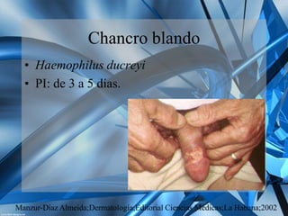 Chancro blando | PPTX