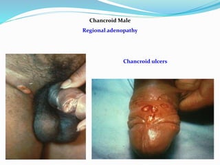 Chancroid Male
Regional adenopathy
Chancroid ulcers
 