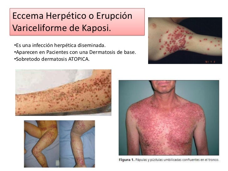Como curar la psoriasis anal