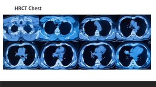 Appa Raddiology ABPA RADDIOLOGY MEET_DR CHANDAN SHEET.pdf
