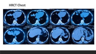 Appa Raddiology ABPA RADDIOLOGY MEET_DR CHANDAN SHEET.pdf