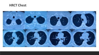 Appa Raddiology ABPA RADDIOLOGY MEET_DR CHANDAN SHEET.pdf