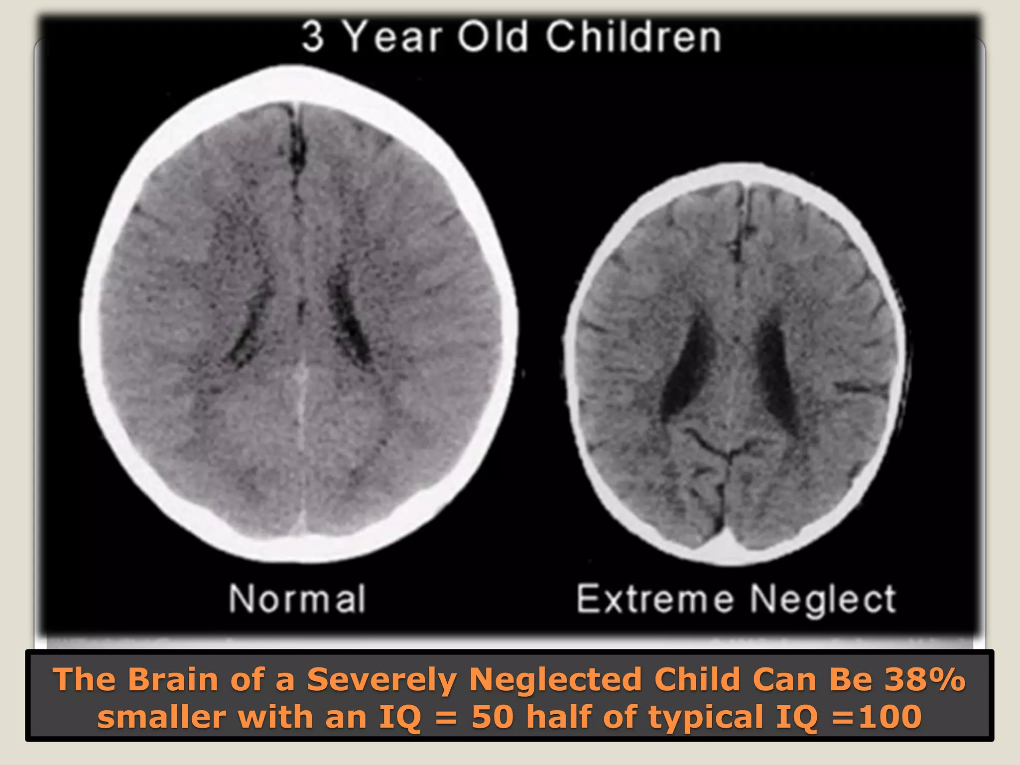 The Brain of a Severely Neglected Child Can Be 38%
smaller with an IQ = 50 half of typical IQ =100
 