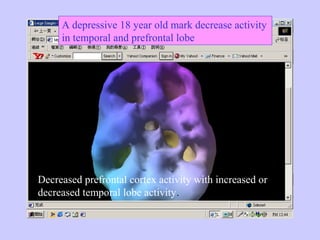 A depressive 18 year old mark decrease activity
in temporal and prefrontal lobe
Decreased prefrontal cortex activity with increased or
decreased temporal lobe activity.
 