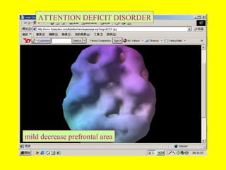 mild decrease prefrontal area
ATTENTION DEFICIT DISORDER
 