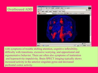 Overfocused ADD
with symptoms of trouble shifting attention, cognitive inflexibility,
difficulty with transitions, excessive worrying, and oppositional and
argumentative behavior. There are often also symptoms of inattention
and hyperactivity-impulsivity. Brain SPECT imaging typically shows
increased activity in the anterior cingulate gyrus and decreased
prefrontal cortex activity.
 