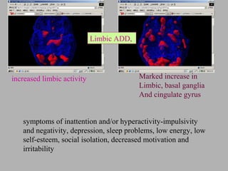 increased limbic activity
symptoms of inattention and/or hyperactivity-impulsivity
and negativity, depression, sleep problems, low energy, low
self-esteem, social isolation, decreased motivation and
irritability
Limbic ADD,
Marked increase in
Limbic, basal ganglia
And cingulate gyrus
 