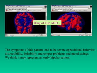 Ring of Fire ADD -
The symptoms of this pattern tend to be severe oppositional behavior,
distractibility, irritability and temper problems and mood swings.
We think it may represent an early bipolar pattern.
 
