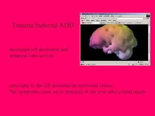 especially to the left dorsolateral prefrontal cortex.
The symptoms come on or intensify in the year after a head injury.
Trauma Induced ADD
decreased left prefrontal and
temporal lobe activity
 